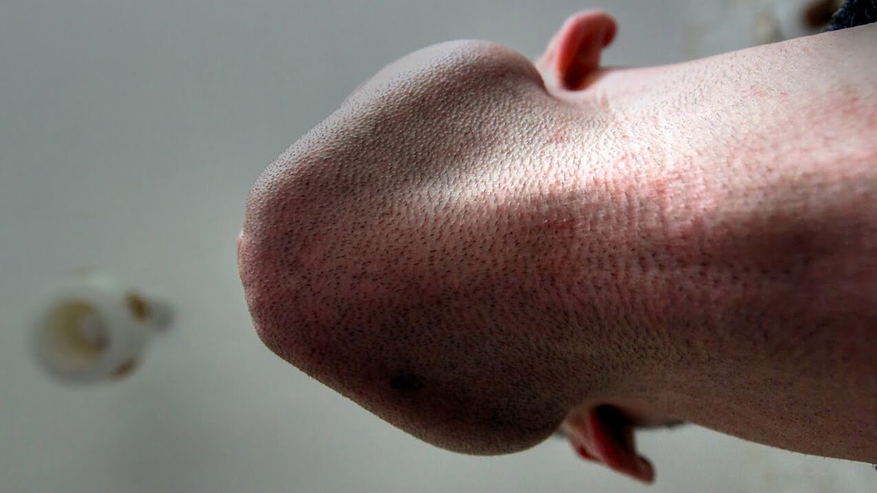 Algunos productos para agrandar la cabeza del pene pueden provocar alergias.