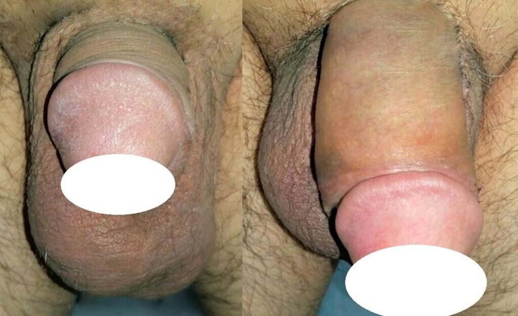Fotos antes y después del agrandamiento del pene.